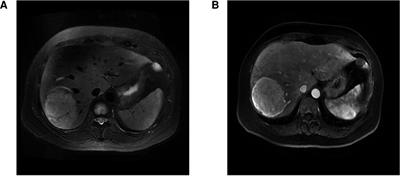 Hepatic inflammatory myofibroblastic tumor: One case report